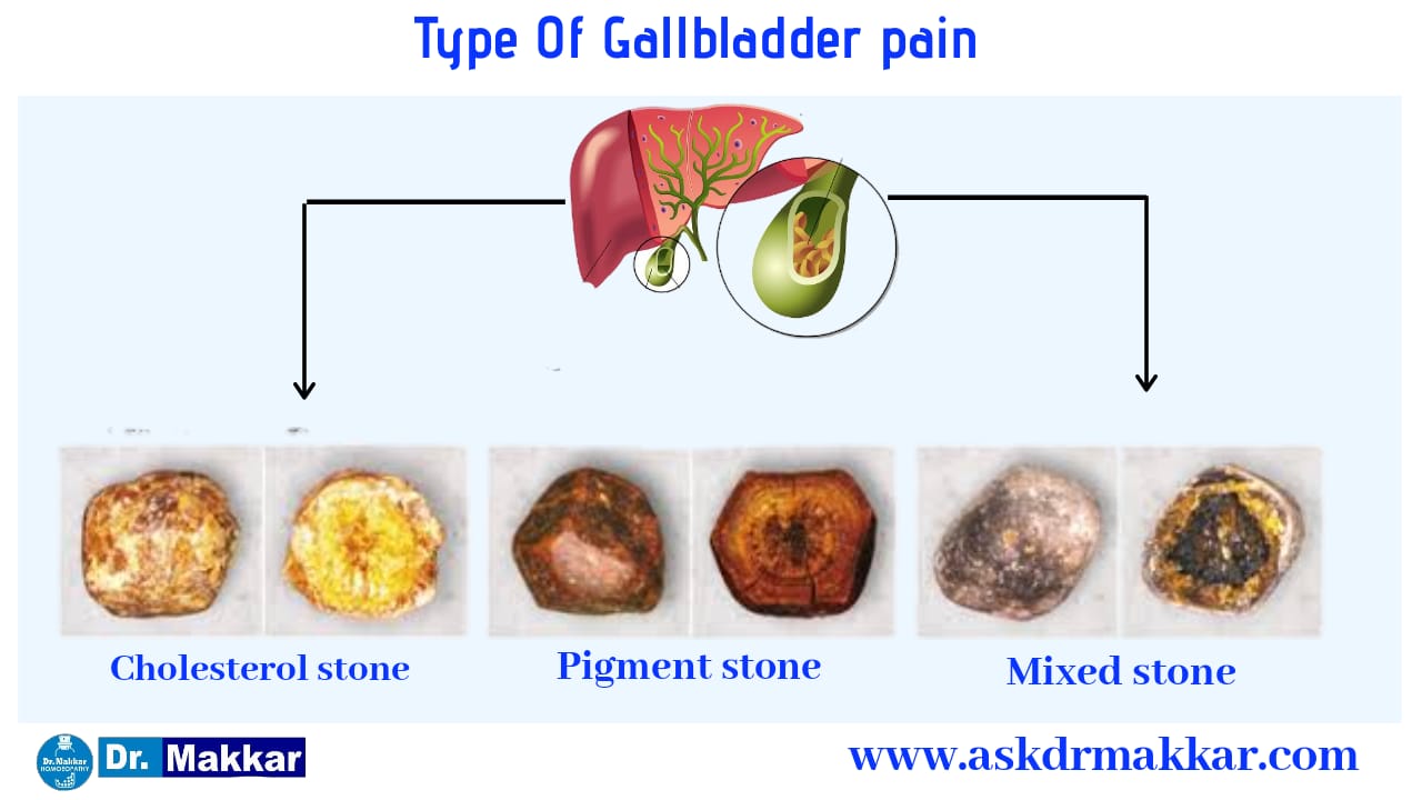 Gallstones Cholelithesis Homeopathic Treatment Gall Bladder Stone